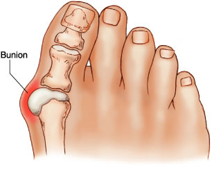 Solution for Bone Bumps: Forelli Shoes